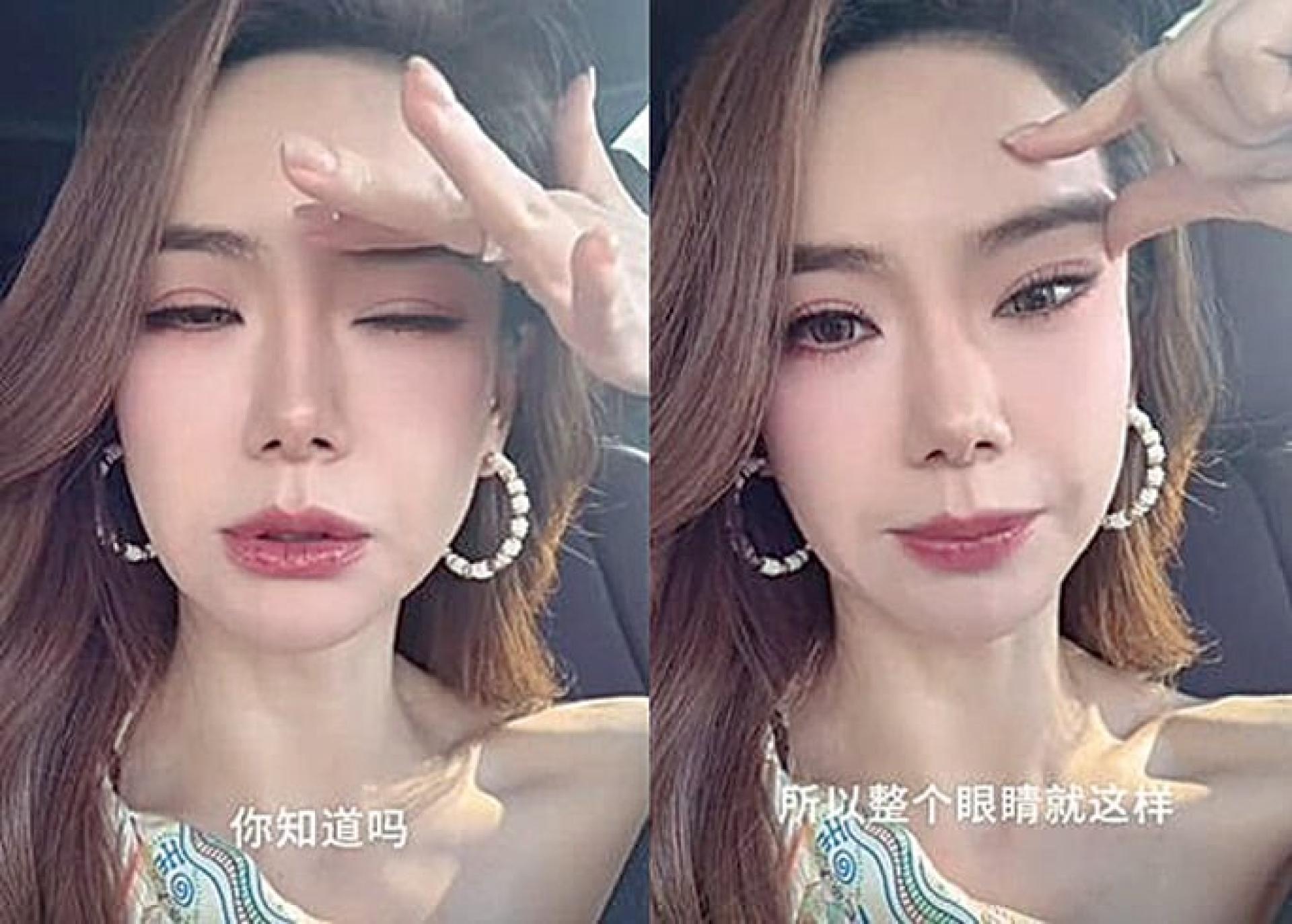 戚薇肉毒打过量。