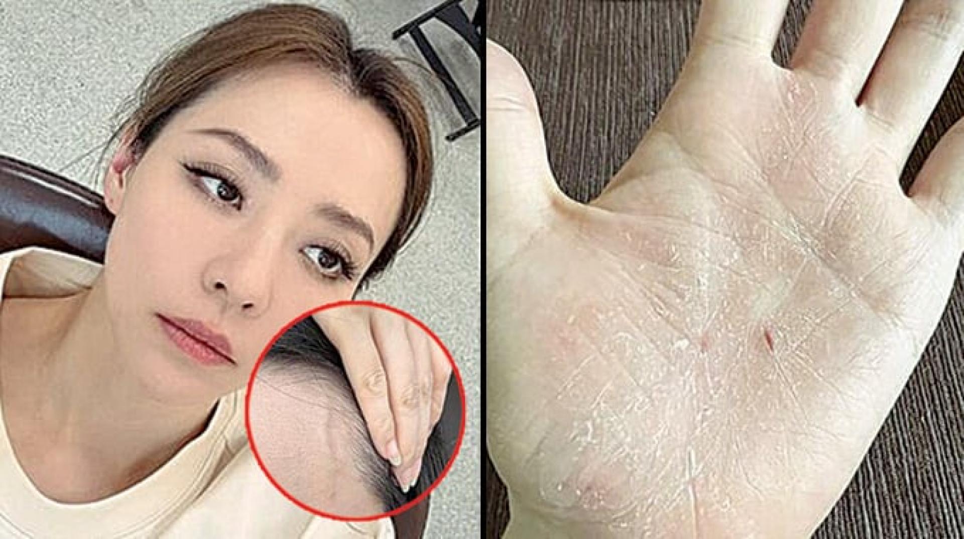 张靓颖额头诡异浮起，伸懒腰就让手掌流血。