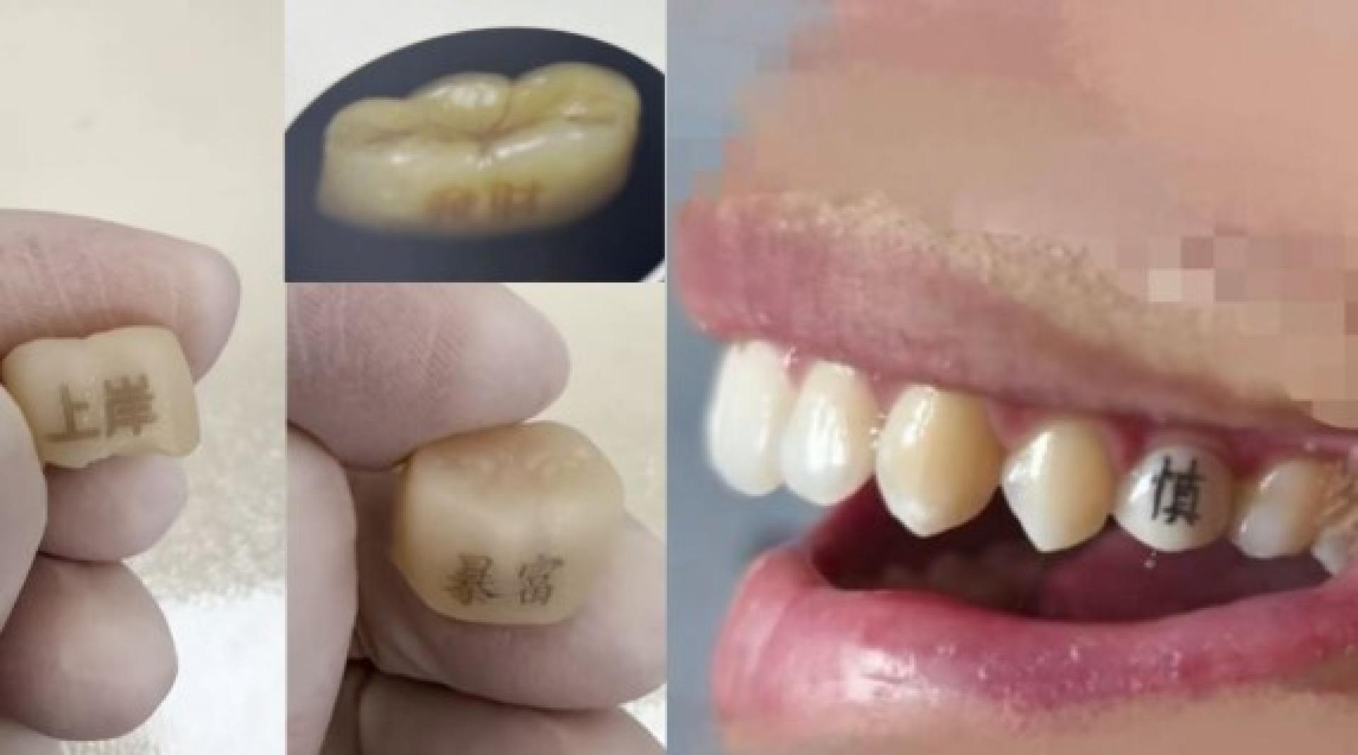 近期不少年轻患者询问在牙冠上刻字，其中“发财”、“上岸”等吉祥字样最受欢迎。