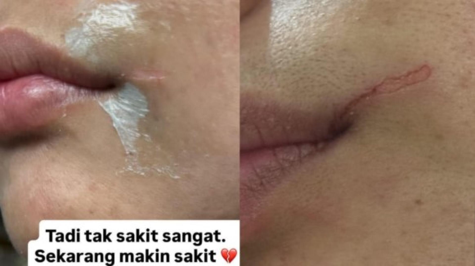 这名女子被医疗器材刮到她的脸导致流血及留下伤痕。