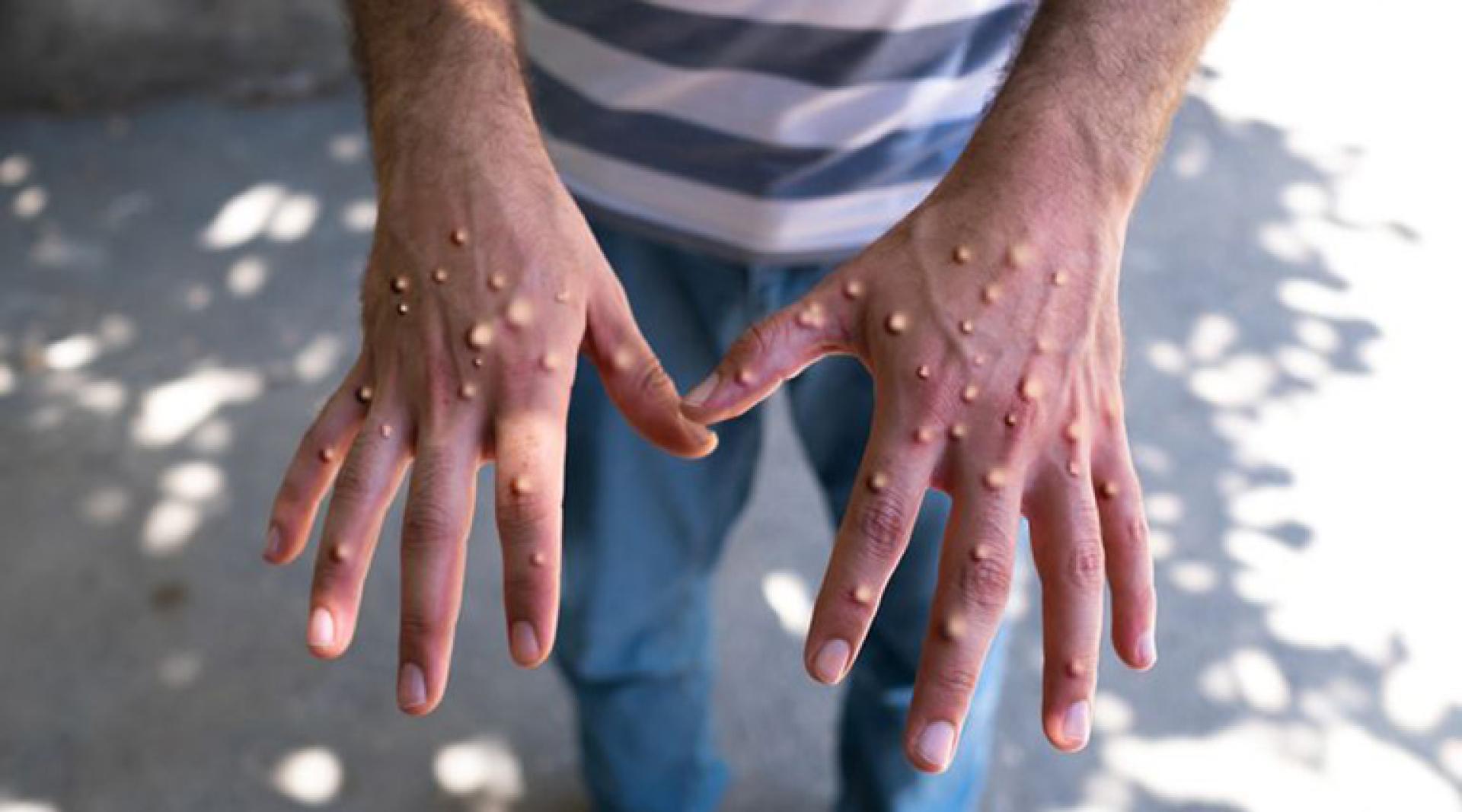 世卫曾宣布M痘疫情构成国际关注的突发公共卫生事件。