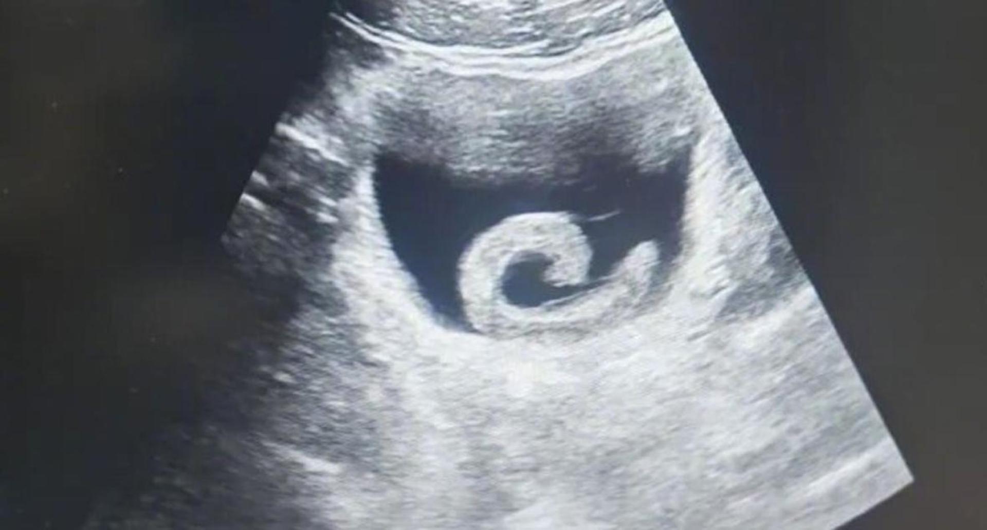 超声波检查下，水蛭被发现在病人膀胱内寄居。