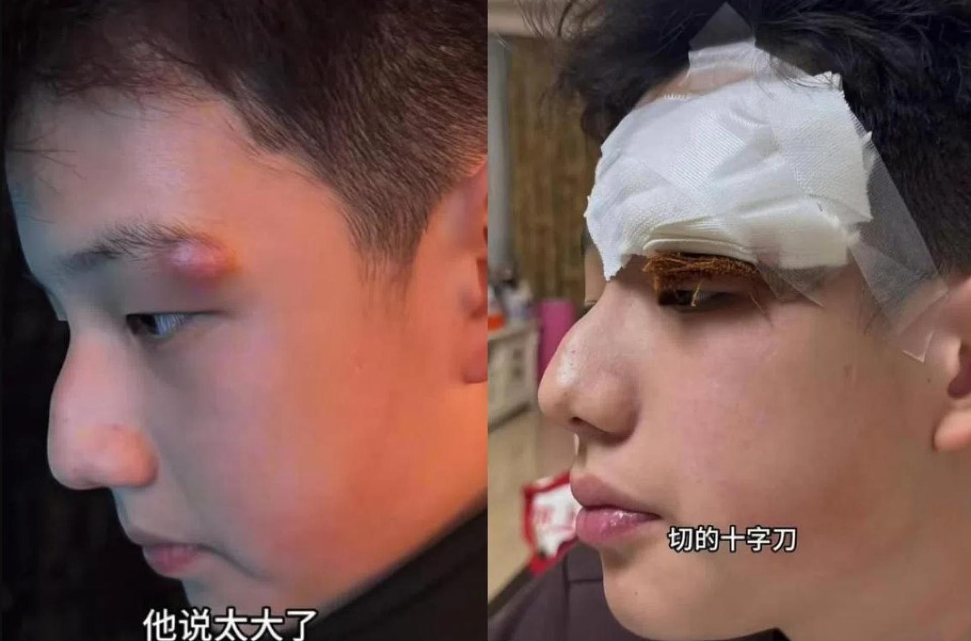 中国女演员关凌的儿子眉尾处长了一个包，被针挑过后，必须缝针处理。