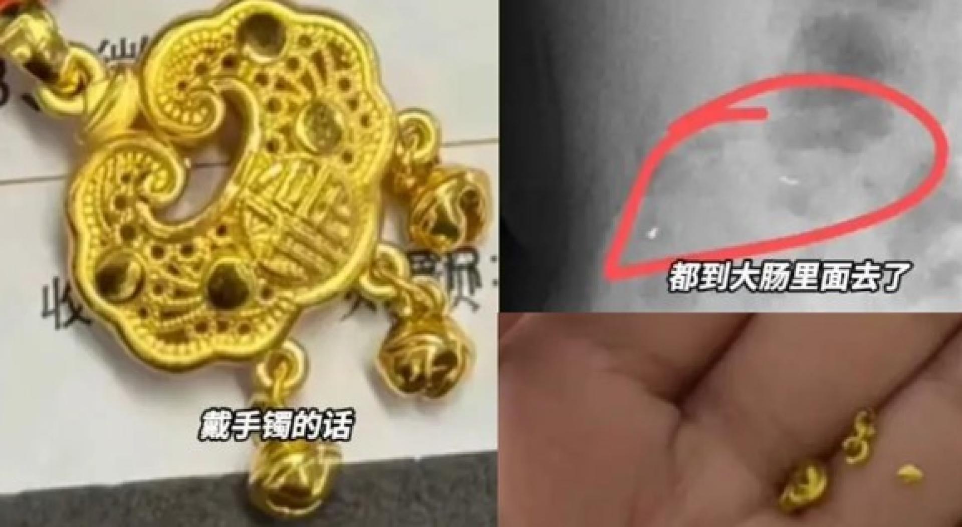 医生诊断，孩子吞下去的黄金碎片已经进入大肠，下来要确认碎金是否能随粪便排出。