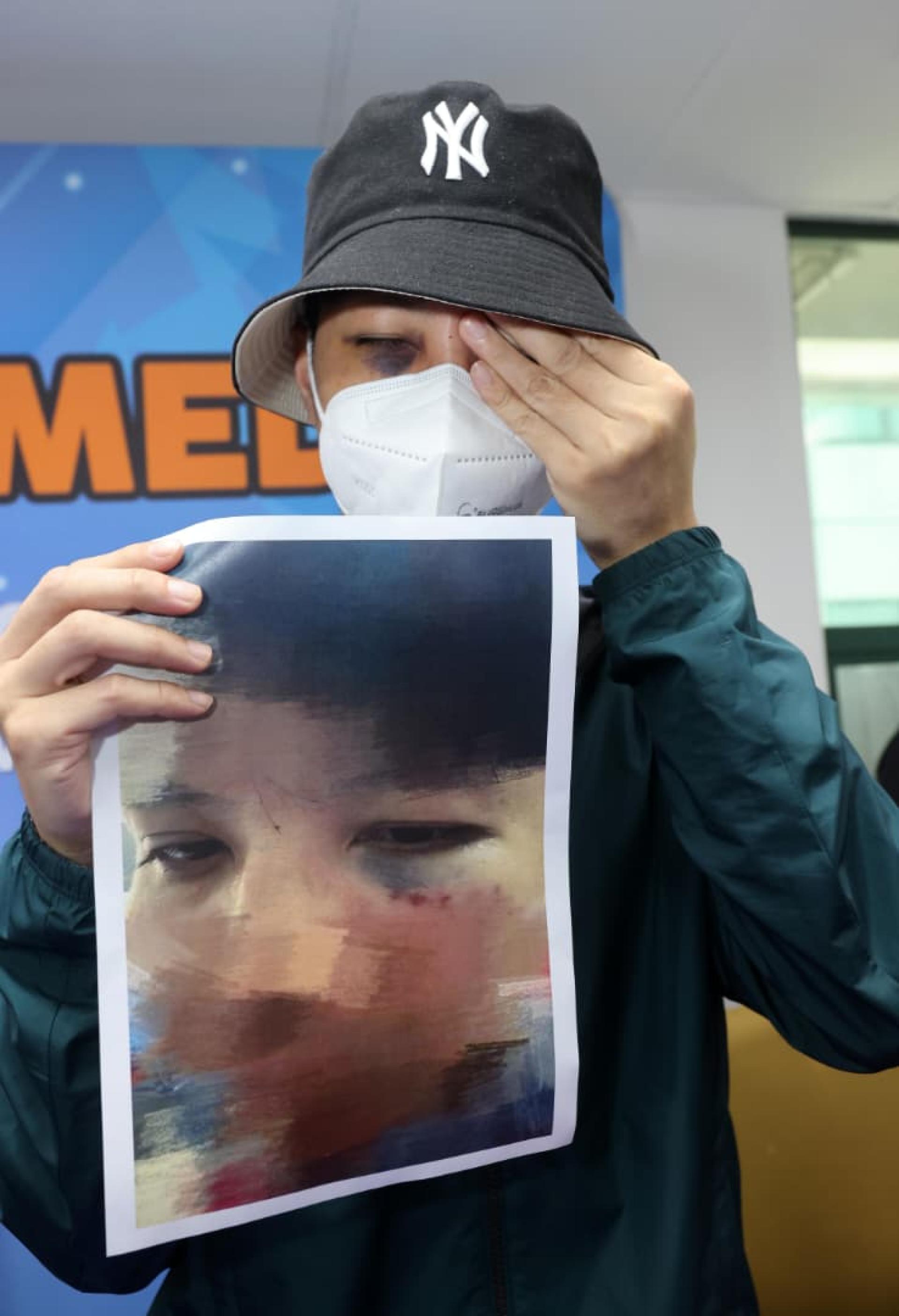 事主右眼遭到攻击，迄今伤势迄今还没消退。