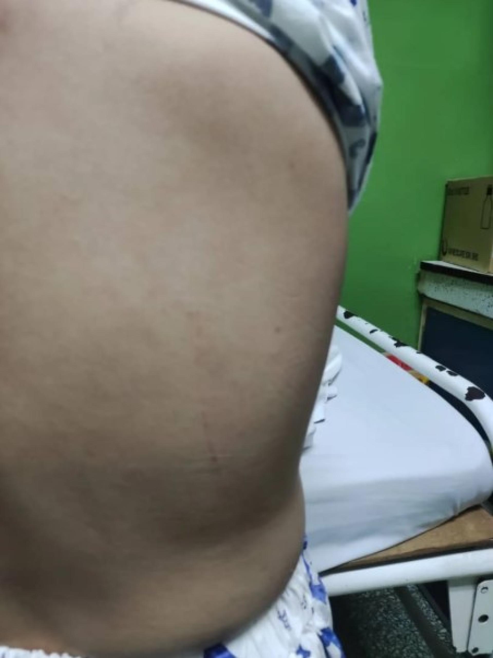 学生背部因遭水管打击而受伤。