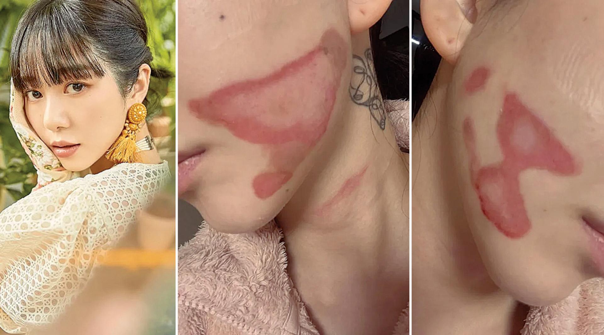 珉娥曝光脸部伤势。