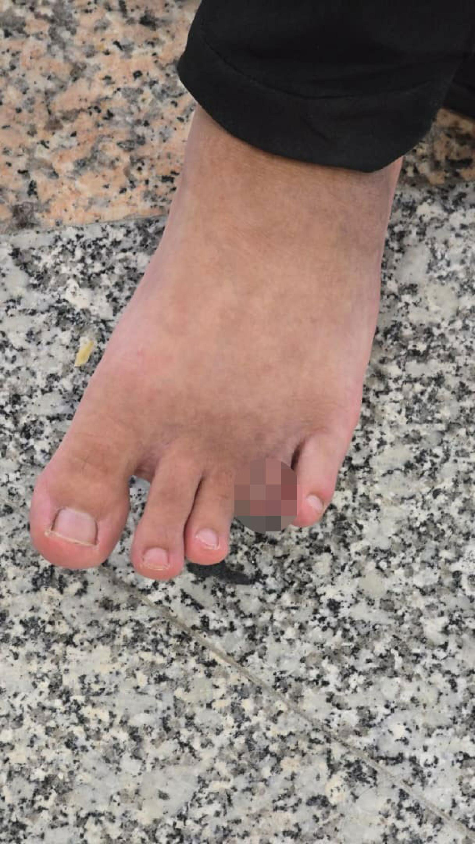 事主的左脚無名趾重伤感染，被迫截除。