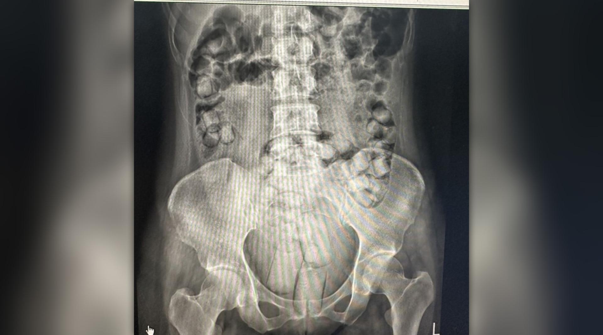 当局对涉案女子照X光后，发现对方体内均有大量块状物体。