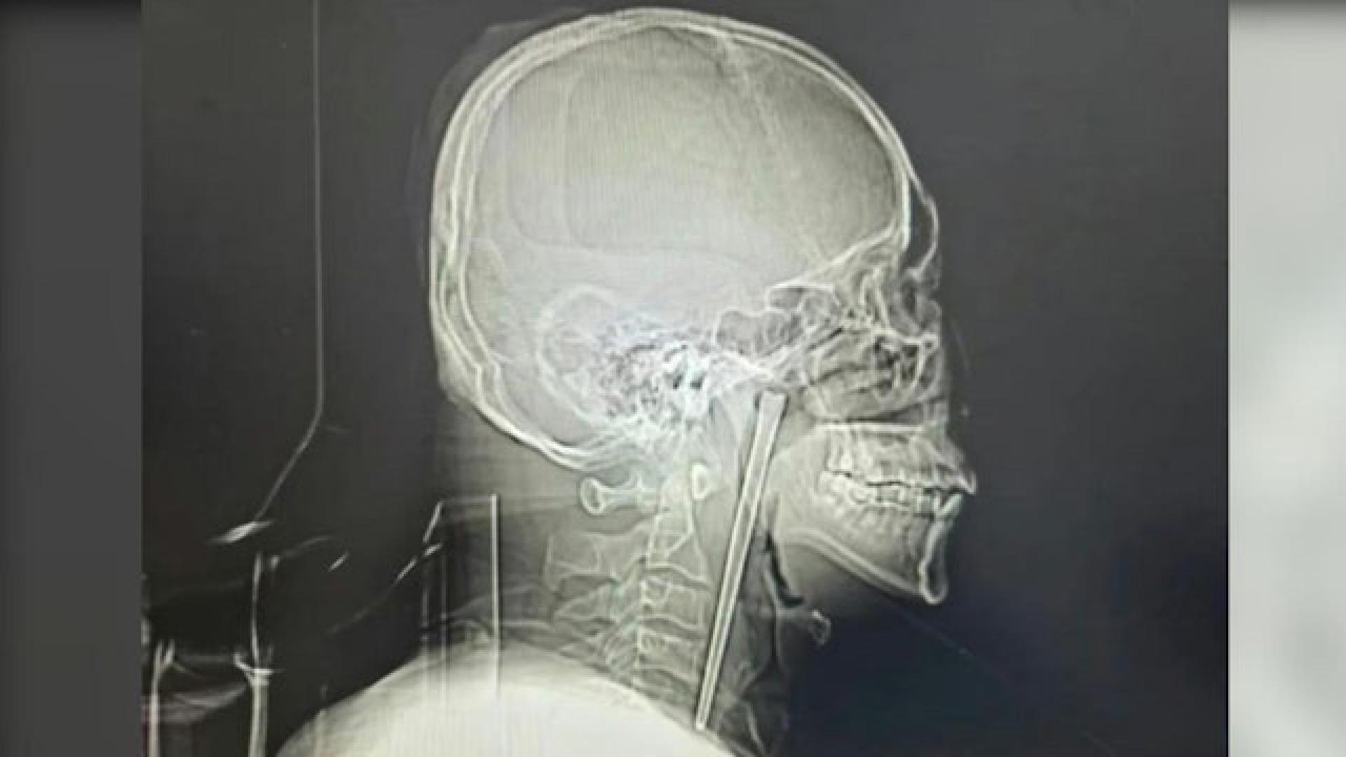 男子咽喉部竟插著一根长达12厘米的金属筷子，且已在体内留存长达8年之久。