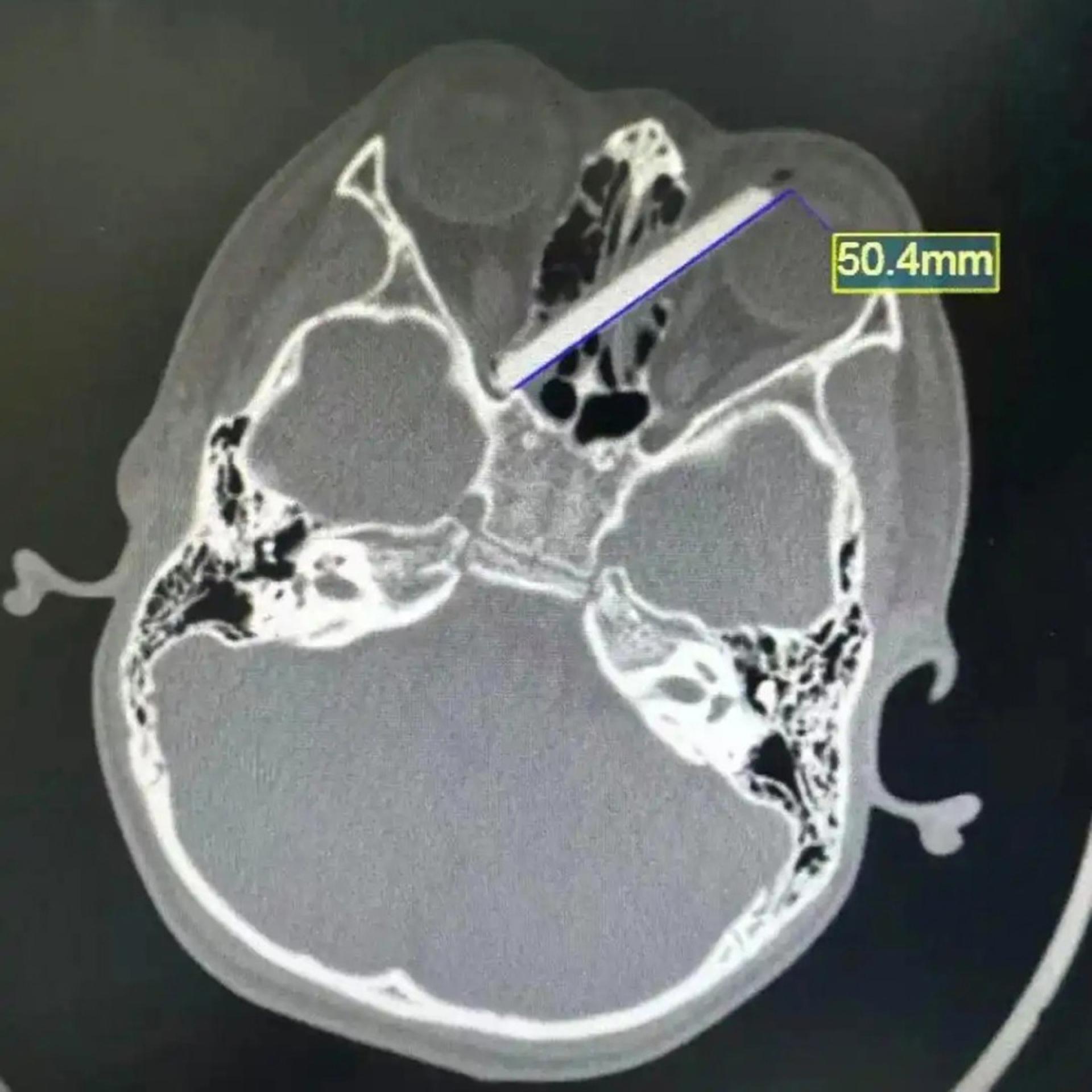 7岁童吃饭跌倒，5厘米的断筷，竟直接由其左眼插入，贯穿鼻窦。