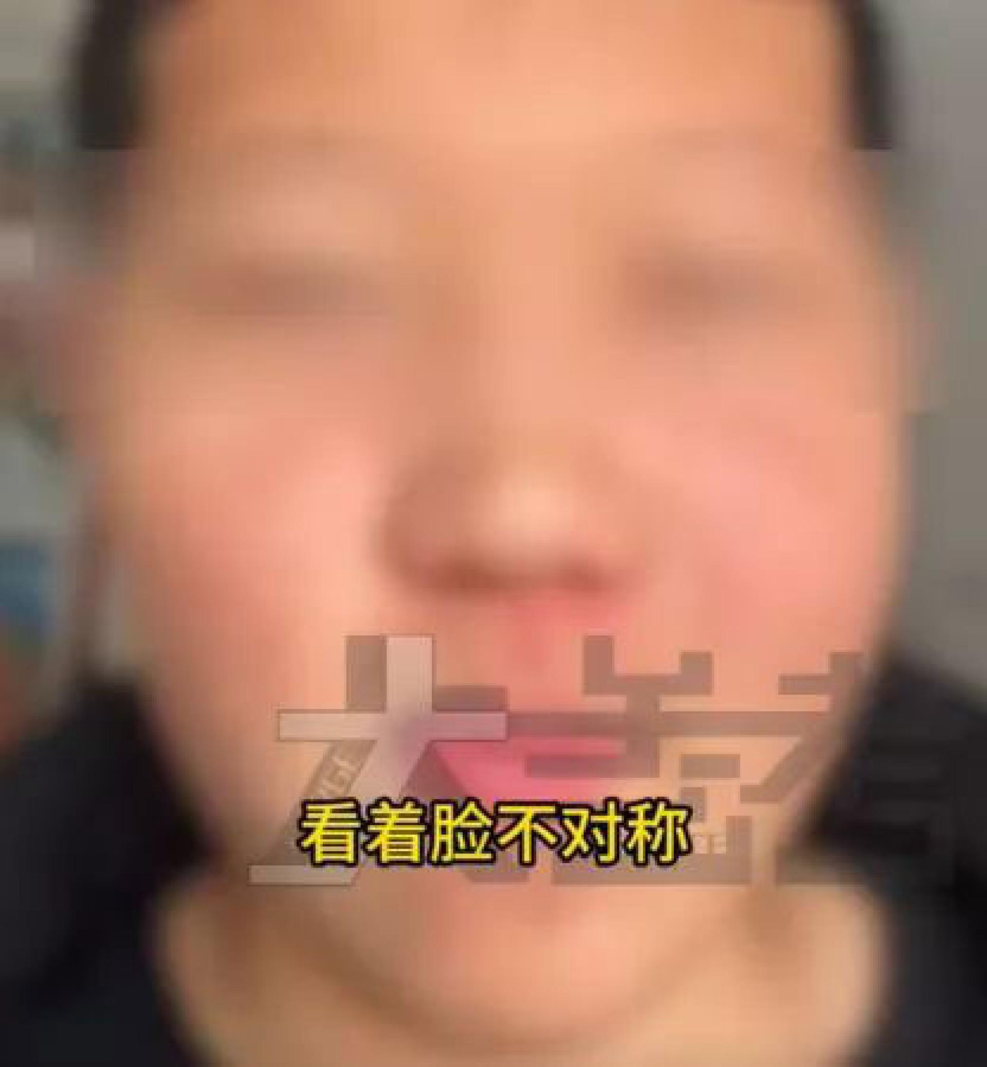 15岁少年左脸突然肿大、脸部逐渐出现歪斜，竟是异常生长的智齿被囊肿顶到眼窝附近。