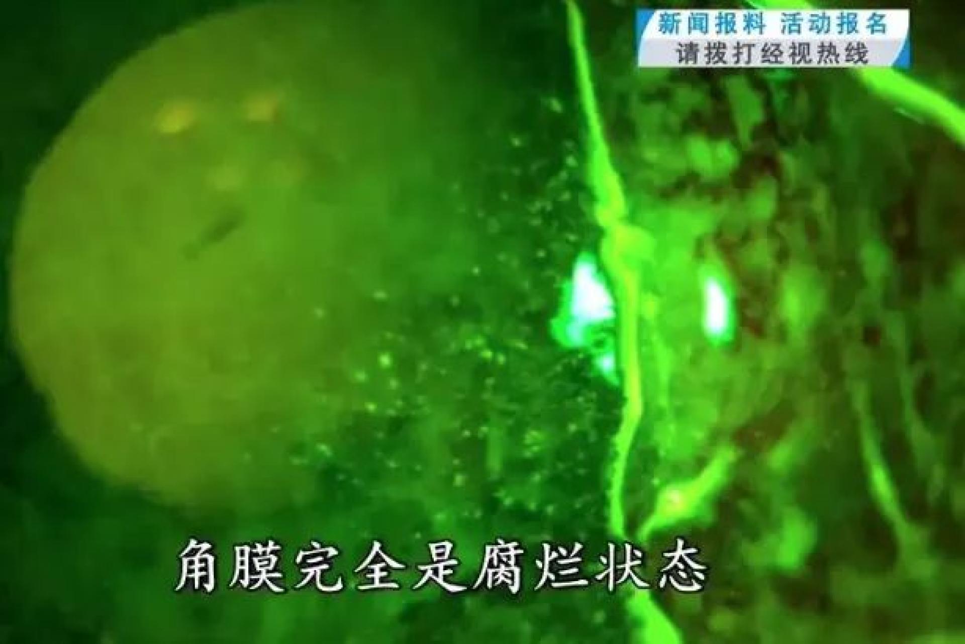 男子的眼角膜全腐烂。