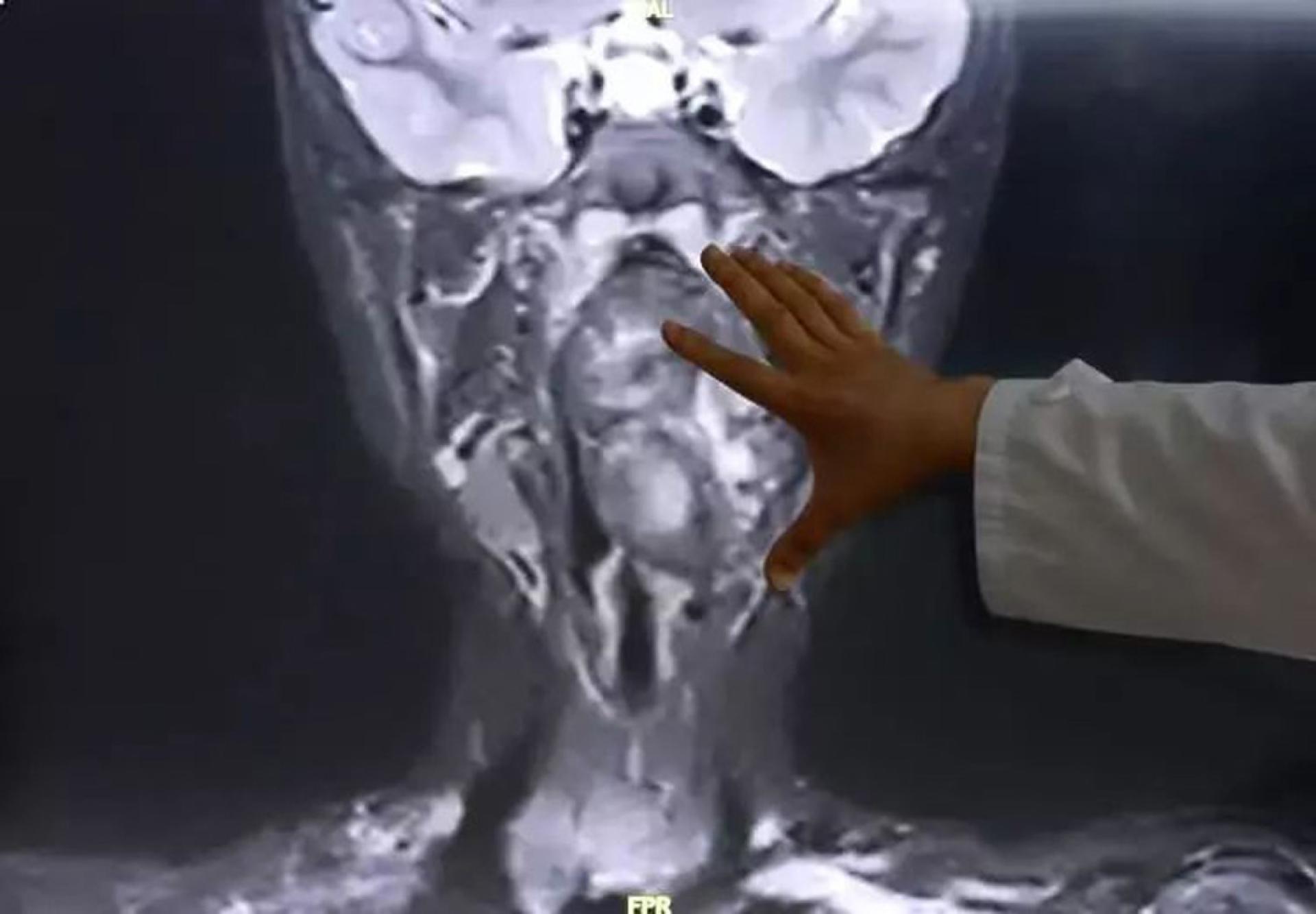 男童狂打鼻鼾还挑食，求医揭咽喉藏6.6厘米畸胎瘤险窒息。