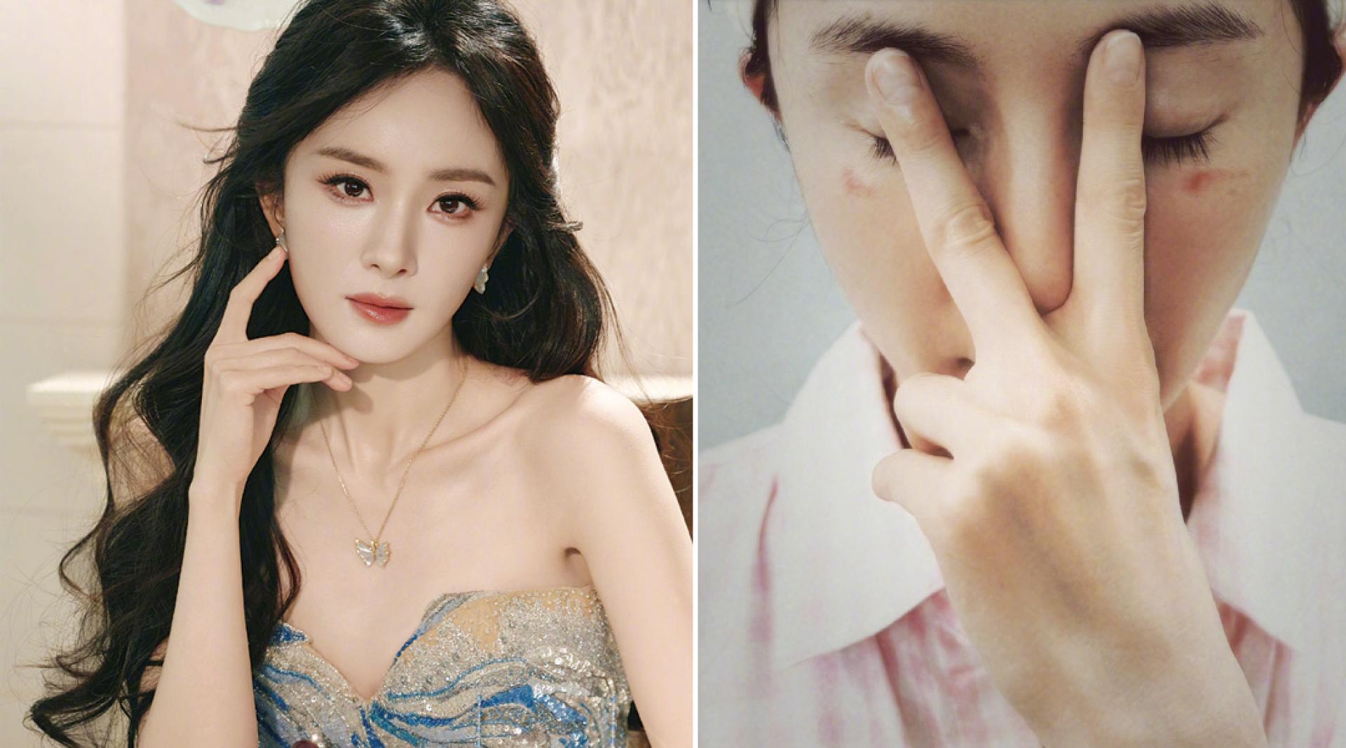 杨幂的脸遭低温烫伤。