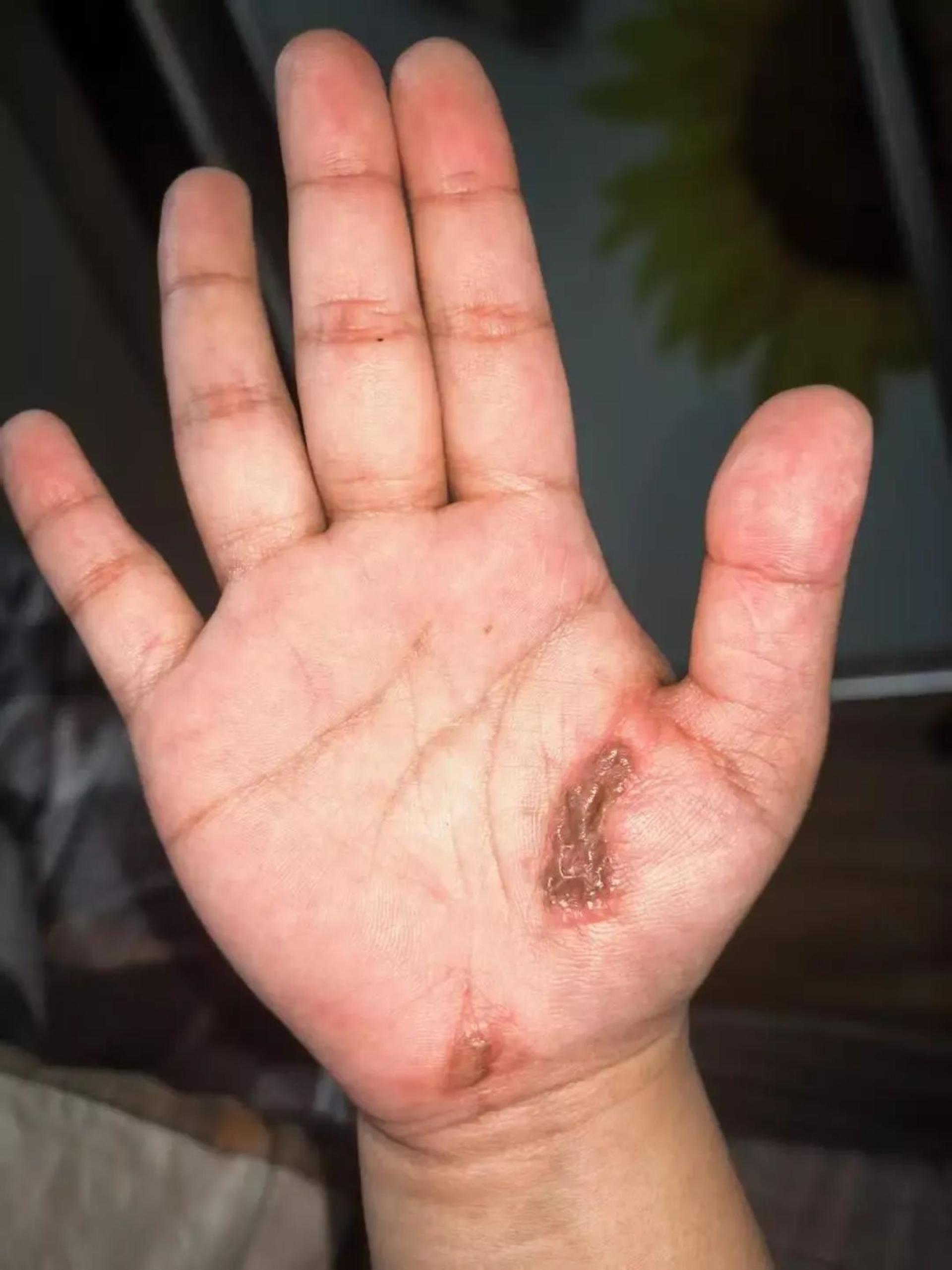 孙女士手掌留下的伤疤。